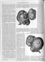 Fig. 1 et 2. [Fibrome utérin] - Gazette médicale de Paris : journal de médecine et des sciences acce [...]