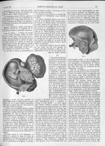 Fig. 3 et 4. [Fibrome utérin] - Gazette médicale de Paris : journal de médecine et des sciences acce [...]
