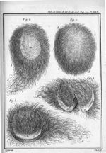 Fig. 1 à 3. Corps de forme ovale et rempli de poils, trouvé dans la matrice d'une fille âgée de cinq [...]