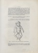 Fig. 1. (D'après un croquis communiqué par M. le Docteur Guéniot) - Des dispositions du cordon (la p [...]