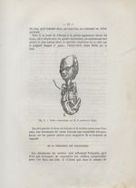 Fig. 2. Foetus communiqué par M. le Professeur Trélat - Des dispositions du cordon (la procidence ex [...]
