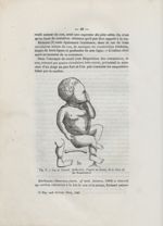Fig. 3. Cas de Siebold. (Réduction, d'après un dessin, de la thèse de De Nonancourt) - Des dispositi [...]