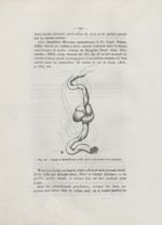 Fig. 12. Noeud de Baudelocque, telle qu'il a été trouvé à la naissance - Des dispositions du cordon  [...]