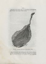 Fig. 20. Insertion vélamenteuse, d'après Lobstein (1801) - Des dispositions du cordon (la procidence [...]