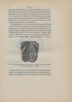 Fig. 3. Polype fibreux fendu attenant encore à l'utérus (d'après Cruveilhier) - Des fibromes utérins [...]