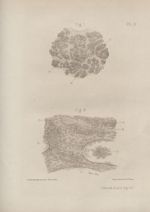 Fig. 1. Tissu utérin immédiatement après l'accouchement / Fig. 2. Fibrome utérin sous-muqueux immédi [...]
