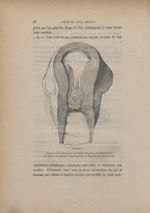 Figure 3. Cancer de la muqueuse cervicale d'après une préparation du musée d'anatomie pathologique d [...]