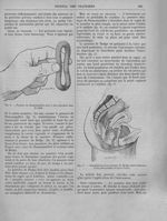 Fig. 3. Pessaire de Dumontpallier prêt à être introduit dans le vagin / Fig. 4. Introduction d'un pe [...]