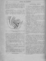 Fig. 5. Pessaire de Hodge en place, maintenant l'utérus réduit (d'après Pozzi) - Revue générale de c [...]