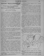 Fig. 1. Observation n° 1 : radiographie précoce - Revue générale de clinique et de thérapeutique - J [...]