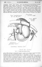 Fig. 4. - Procédé Guyon-Albarran-Marion - Le Concours médical