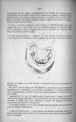 Fig. 3. [Application de l'appareil de Morestin-Ruppe] - Congrès dentaire interalliés, 10-11-12-13 no [...]