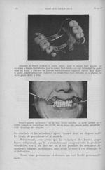 Attaches de Roach à rotule et cadre placés / L’appareil en bouche - L'Odontologie