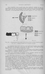 Fig. 5 a / Fig. 5 b. — Remplacement d'une dent à tube par Une dent en résine à insertion jugale / Fi [...]