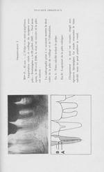 Observation pulpe à nu sans symptômes / observation Iatteinte de pulpide - L'Odontologie