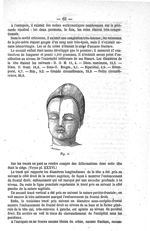 Fig. 3. [Grossesse gémellaire, tête du second enfant, présentant un sommet déformé] - De la tête du  [...]