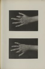 Pl. 2. - [Spina ventosa, main droite et main gauche, chez un même enfant] - Applications de la Photo [...]
