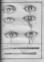 Planche XX. [Description et instruments pou guérir la cataracte par l'extraction du cristallin] - Su [...]