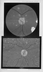 Fig. 1. Mr. Mules' case of primary retinal phlebitis / Fig. 2. Mr. Hartridge's case of disseminated  [...]