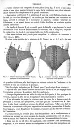 Fig. 7. Ceinture eutocique du docteur Pinard, appliquée et vue latéralement / Fig. 8. Ceinture eutoc [...]
