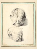 Fig. 1 Face intérieure du cuir chevelu / Fig. 2 Cerveau in situ - Dessins originaux
