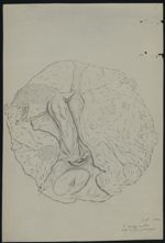 Enveloppe du fœtus - Observations chirurgicales. 23 dessins originaux (avec quelques reproductions l [...]