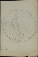 [Enveloppe du fœtus] - Observations chirurgicales. 23 dessins originaux (avec quelques reproductions [...]