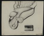 Hernie inguinale - Observations chirurgicales. 23 dessins originaux (avec quelques reproductions lit [...]