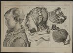 Pl. II. Fig. I à Fig. IV - Observations chirurgicales. 23 dessins originaux (avec quelques reproduct [...]