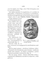 Fig. 1 : Acné polymorphe. C. A. F. Collection A. Fournier, 1132, moulage Baretta - Hygiène du visage [...]