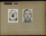 [Cas de traumatisme maxillaire 73 / Deux portraits de face préopératoires] / "Lyon (100 Gde rue de l [...]