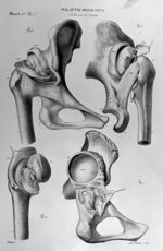 Malattie della ossa, lussazione del femore - Atlante general della anatomia patologica del corpo uma [...]