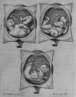 De l'accouchement auquel l'enfant présente le ventre, ou la poitrine, ou le costé - Les maladies des [...]