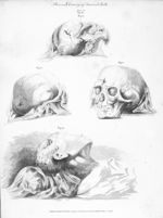 Plans and drawings of fractured skulls - The principles of surgery