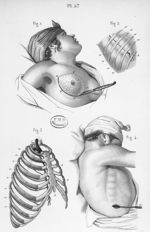 Extirpation du sein. Empyème - Précis iconographique de médecine opératoire et d'anatomie chirurgica [...]