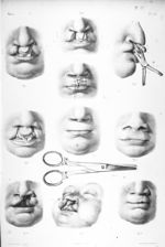 Becs-de-lièvre - Traité complet de l'anatomie de l'homme comprenant la médecine opératoire