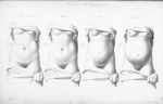 Histoire de la grossesse - Nouvelles démonstrations d'accouchements