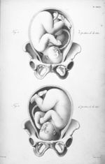 Positions de la tête - Nouvelles démonstrations d'accouchements