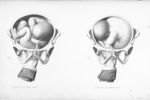 Positions de la hanche gauche - Nouvelles démonstrations d'accouchements