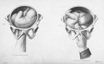 Positions de l'épaule gauche - Nouvelles démonstrations d'accouchements