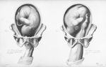 Positions de l'occiput - Nouvelles démonstrations d'accouchements