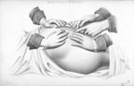 Opération césarienne: méthode des anciens - Nouvelles démonstrations d'accouchements