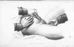Opération césarienne: passage du cordon pour la délivrance - Nouvelles démonstrations d'accouchement [...]