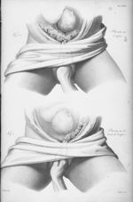 Placenta sur l'orifice, sur les bords de l'orifice - Nouvelles démonstrations d'accouchements