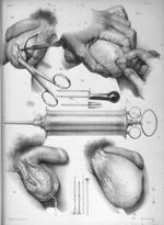 Opérations curatives de l'hydrocèle - Traité complet de l'anatomie de l'homme comprenant la médecine [...]