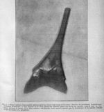 Fémur atteint d'ostéomyélite photographié à travers des tissus de la cuisse - Revue générale des sci [...]