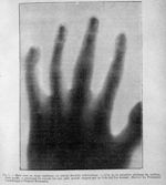 Main dont un doigt (médium) est atteint d'ostéite tuberculeuse - Revue générale des sciences pures e [...]