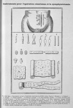 Instruments servant à l'opération césarienne au XVIIIe siècle, d'après J. Mesnard - Histoire des acc [...]