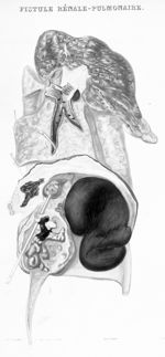 Fistule rénale-pulmonaire - Traité des maladies des reins