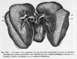 Le coeur et les poumons vus par leur face postérieure - Traité d'anatomie pathologique